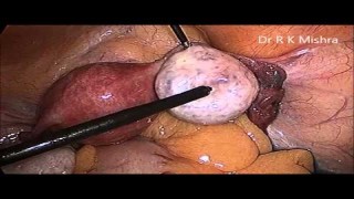 Laparoscopic Tubal Patency test and Ovarian Drilling for PCOS