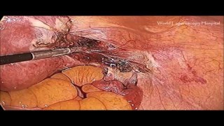 Total Laparoscopic Hysterectomy with RoBi and Ultrasonic Dissector