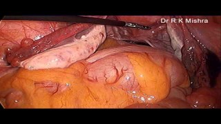 Lap and Dye Test (Laparoscopic Tubal Patency Test)