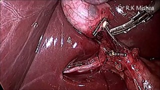 Lap. Chole With Mini Eligator