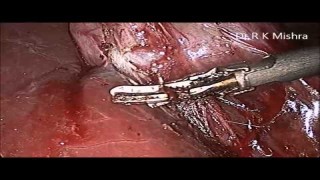 Laparoscopic Cholecystectomy, Sterilization and Appendectomy in same Patient