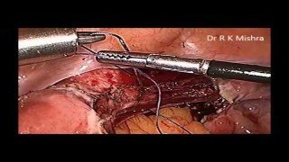 Laparoscopic Appendicectomy & Total Laparoscopic Hysterectomy in Same patient