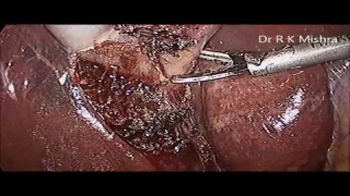Two Port Laparoscopic Cholecystectomy
