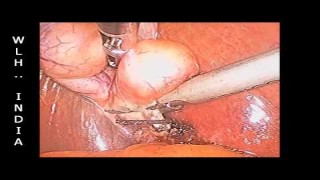 Laparoscopic Cholecystectomy by Extracorporeal knot
