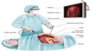Laparoscopic Myomectomy