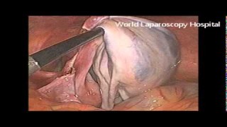 Oophorectomy with Minilap Elegator