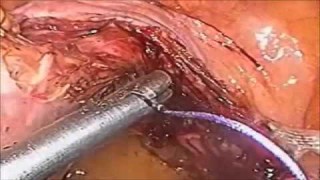 Total Laparoscopic Hysterectomy by Meltzer's Knot