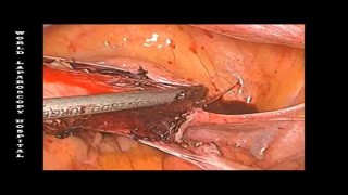 Total Laparoscopic Hysterectomy without Uterine Manipulator