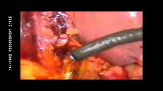 Choledocoscopy at World Laparoscopy Hospital