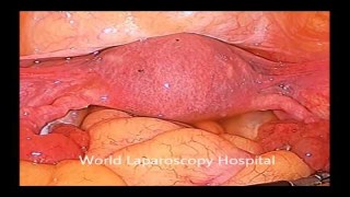 Laparoscopic Tubal Patency Test with Methylene Blue Dye