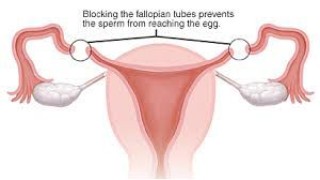 Dr R K Mishra demonstrating Laparoscopic Sterilization with Harminic Scalpel