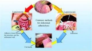 Fibrin Glue for Adhesion Prevension after Laparoscopic Surgery
