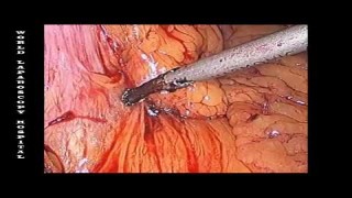 Sleeve Gastrectomy by Dr. R.K. Mishra at World Laparoscopy Hospital