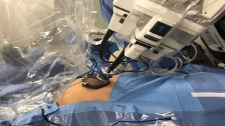 da Vinci Robotic Cholecystectomy for Mirizzi's syndrome by Dr R K Mishra