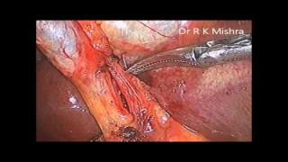 Laparoscopic Cholecystectomy with ligation of Cystic Duct by Dr. R.K. Mishra