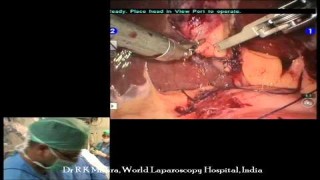 da Vinci Robotic Cholecystectomy by Dr R.K. Mishra