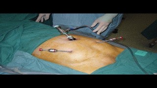 Laparoscopic TAPP Hernia Repair