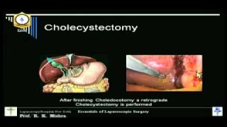 ओपन मायोमेक्टॉमी का वीडियो कई विशाल इंट्राम्यूरल फाइब्रॉएड के लिए बेहतर हैl