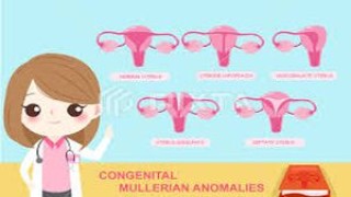 Congenital Müllerian anomalies with two cavitated, non-communicating rudimentary horn