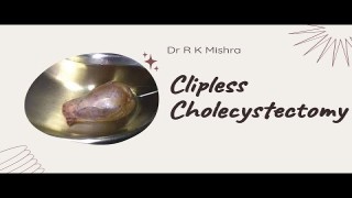 Clipless Laparoscopic Cholecystectomy
