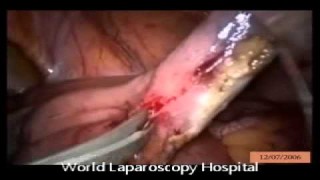 Meckel's Diverticulum Surgery