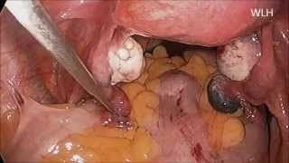 माइनर डिस्टल ट्यूबल फिम्ब्रियल ब्लॉक के लिए लैप्रोस्कोपी का वीडियो देखें