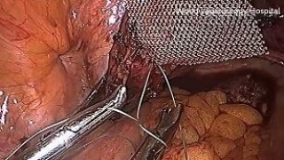 लेप्रोस्कोपिक प्रोमोनोटोफिकेशन द्वारा ग्रेड 4 सिस्टोसेले और हिस्टेरोसेले की मरम्मत का वीडियो देखेंl