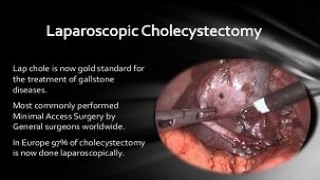 लेप्रोस्कोपिक कोलेसिस्टेक्टोमी नया 'गोल्ड स्टैंडर्ड' का वीडियो देखें।