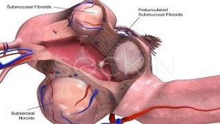 ओपन मायोमेक्टॉमी का वीडियो कई विशाल इंट्राम्यूरल फाइब्रॉएड के लिए बेहतर हैl