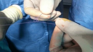Watch the video of Extracorporeal Knot for Laparoscopic Appendectomy
