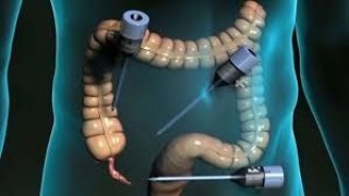 Laproscopic Appendicectomy Lecture by Dr R K Mishra