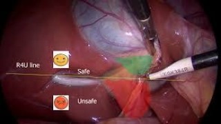 Video of Dangerous way of Performing Laparoscopic Cholecystectomy
