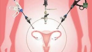 Unedited video of a total laparoscopic hysterectomy