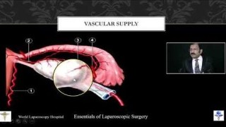 Laparoscopic Surgery for Ectopic Pregnancy - Lecture by Dr R K Mishra