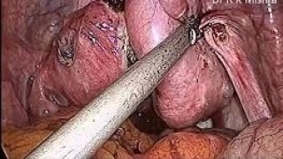 How to perform Safe Laparoscopic Myomectomy - Watch Video of Lecture by Dr. R K Mishra
