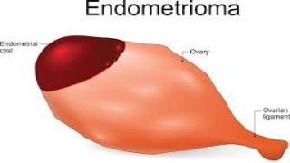 Laparoscopic Surgery for Large Endometrioma