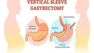 Video of Obesity Surgery - Vertical Sleeve Gastrectomy