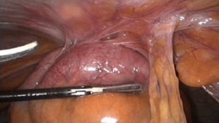 Video of Laparoscopic Incisional Hernia With Massive Adhesion Laparoscopic Repair by Two Ports
