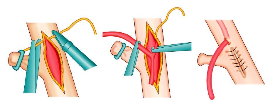 Diagrammatic representation of T tube fixation with an intracorporeal interrupted surgeons knot