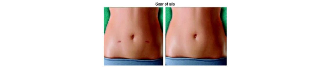 Comparison of scar of SILS and conventional laparoscopic surgery