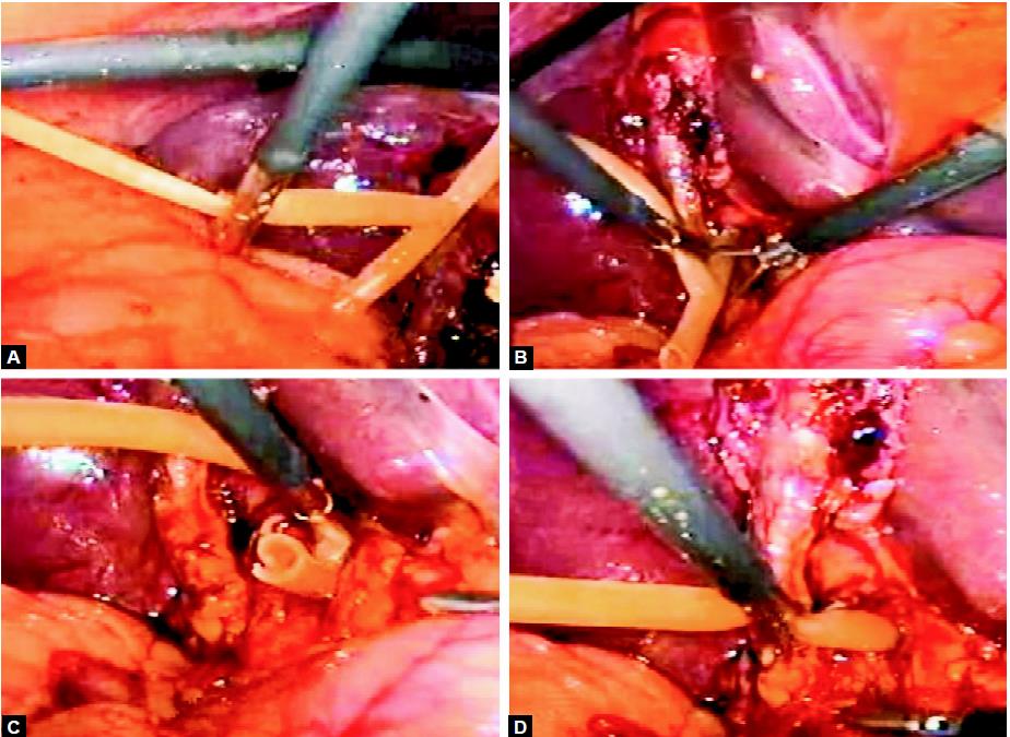 Introduction of T tube