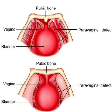 Laparoscopic Burch suspension