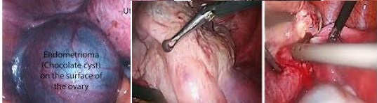 Ovarian endometrioma