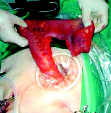 Hand assisted colorectal surgery