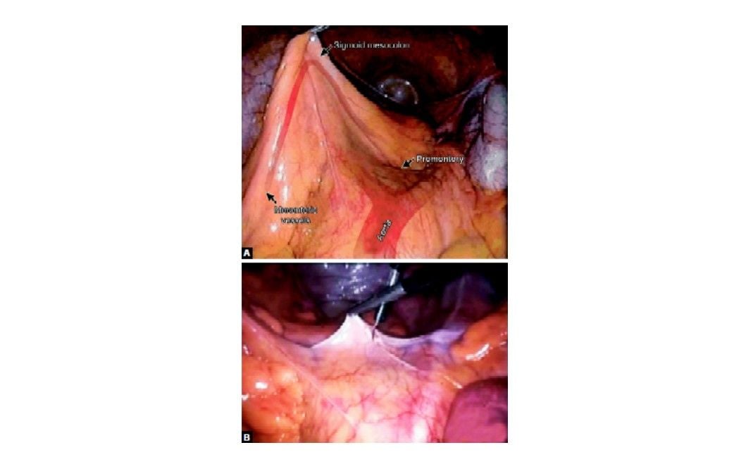 Incision of peritoneum over sacral promontory