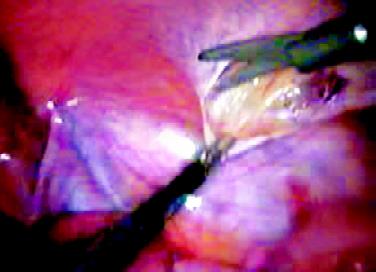 Incision over peritoneum