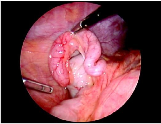 Normal laparoscopic view of the appendix   