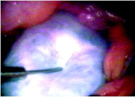 Ovarian cyst is aspirated for ovarian cystectomy