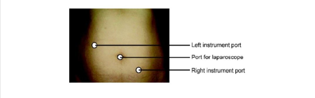 Port position for right sided ovarian surgery