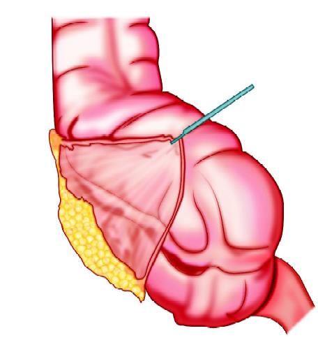 Retrocecal appendix